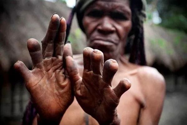 驚悚習(xí)俗！印尼部落女人親人過世就要切斷1截手指哀悼