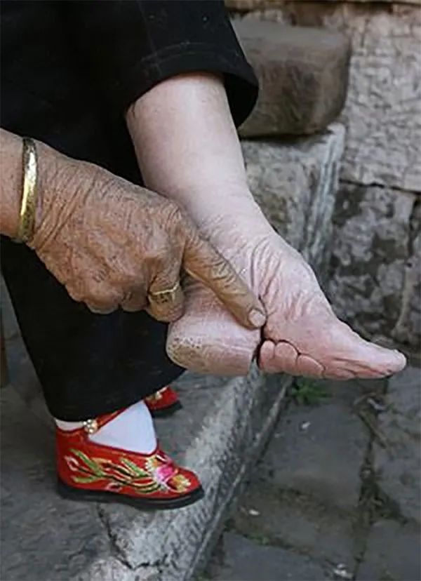 古代傳統極端纏足文化照片，X光看起來太可怕！